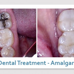 metal free fillings before and after 