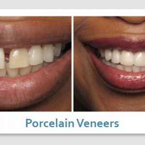 Porcelain veneers las vegas dental patient before and after 