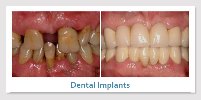 smile_gallery_3c_dental_implants