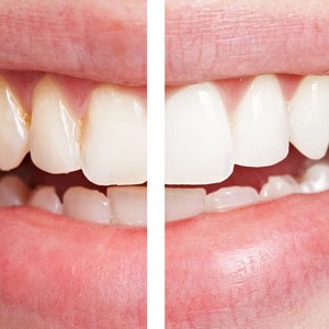 zoom teeth whitening by Las Vegas  dentist 