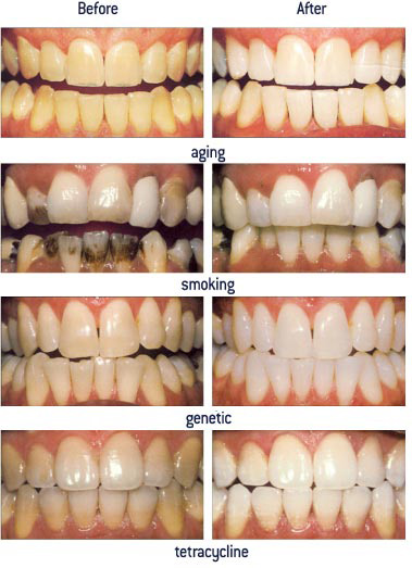 Teeth-Whitening-before-and-after