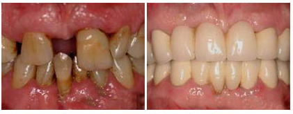 dentures las vegas before and after 